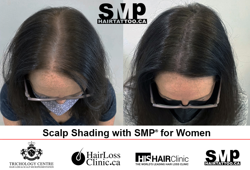 SMP density shading for women