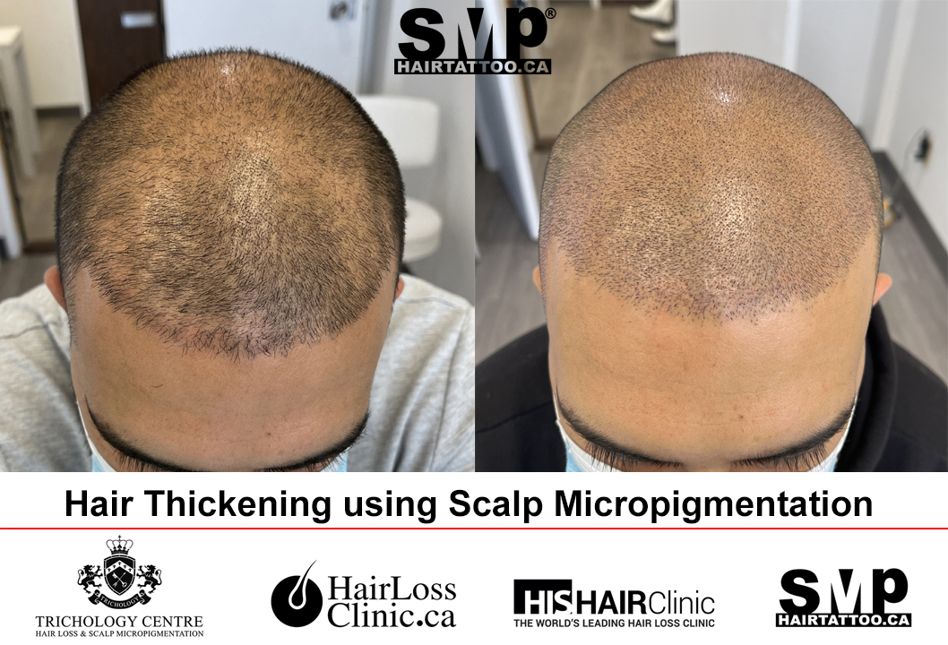 SMP before and after — hairline restoration