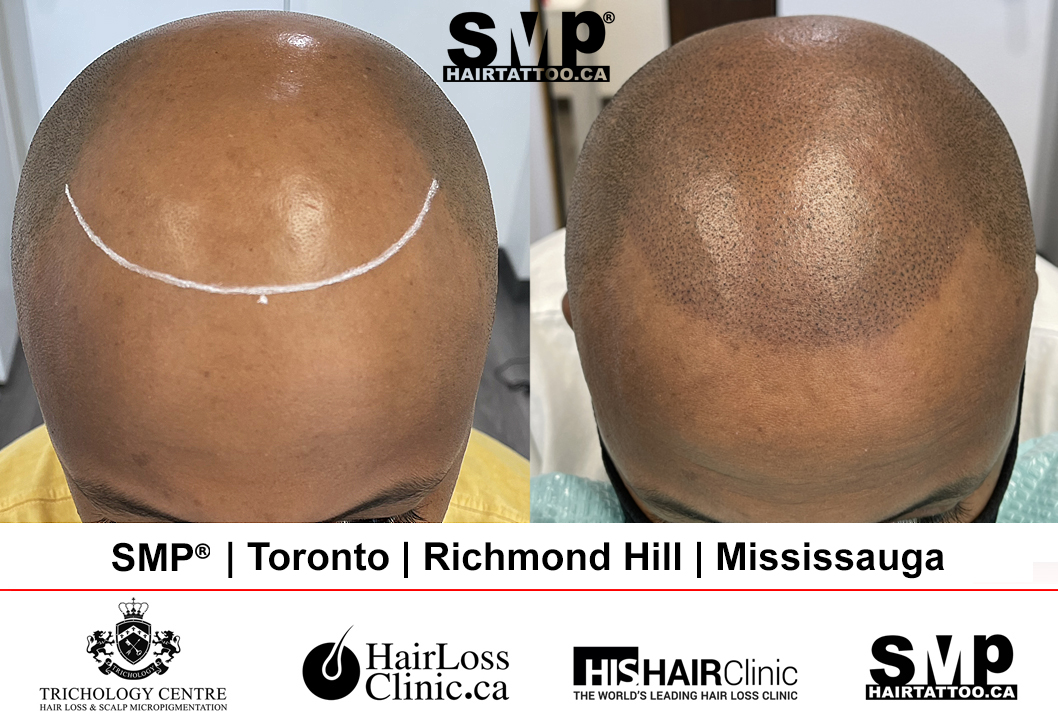 SMP before and after — crown density