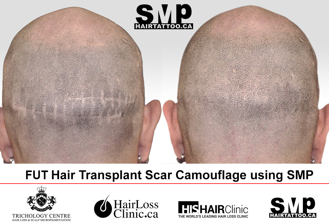 SMP before and after — full coverage profile